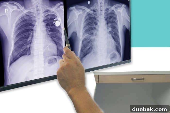Soft and blurry image chest x-ray film of a patient with cardiac pacemaker, also with congestive heart and cardiomegaly. By surgery. And the doctor's hands are checking the size.