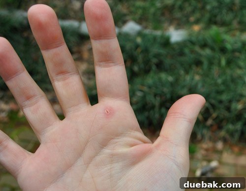 A small blister on the hand, a humorous 'trophy' from the intense tree trimming work.